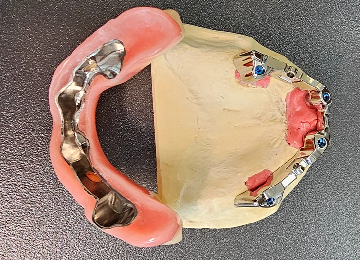leistungen-komplexe-implantate