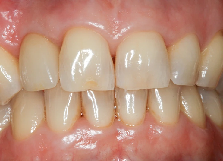 leistungen-kronen-bruecken-veneers